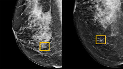 AI in breast cancer screenings
